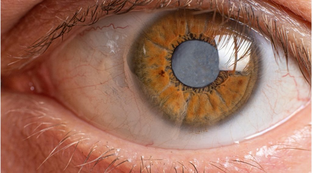 Cataract Treatment​6